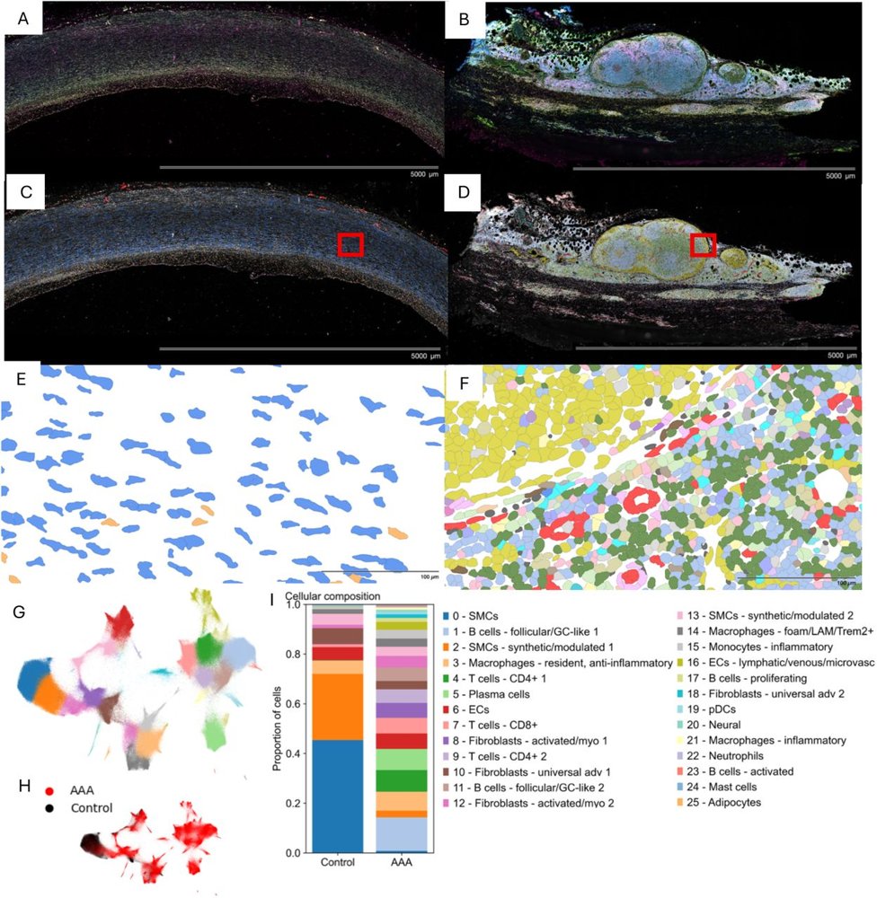 Spatial transcriptomics of control aorta versus abdominal aortic aneurysm: tissue sections, cell segmentation maps, UMAP clustering, and a bar chart showing the aneurysm has far fewer smooth muscle cells and many more immune cell types than control