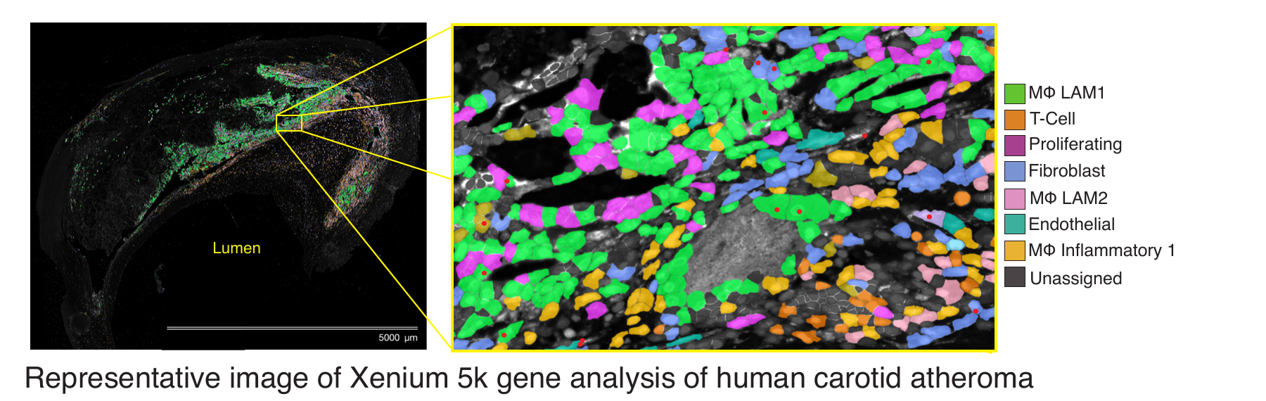Representative image of Xenium 5k gene analysis of human carotid atheroma, showing a whole-section scan with a zoomed inset labeled by cell type: MΦ LAM1, T-cell, proliferating, fibroblast, MΦ LAM2, endothelial, MΦ inflammatory 1, and unassigned
